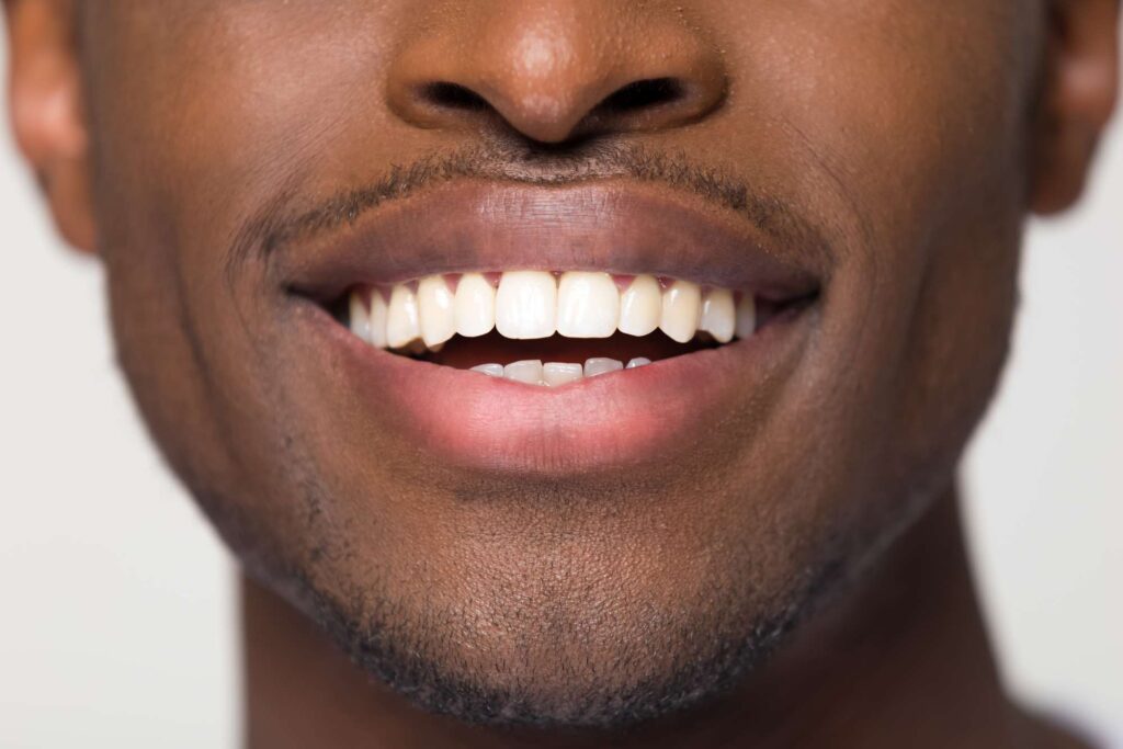 Tooth Bonding Services At Lake Park Dental